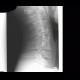Congenital block of cervical vertebra: X-ray - Plain radiograph