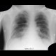 Intraaortic contrapulsation: X-ray - Plain radiograph