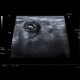 Acute appendicitis, fecolith: US - Ultrasound