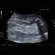 Acute appendicitis, fecolith: US - Ultrasound