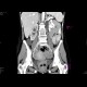 Krukenberg tumor, ovarian metastases from stomach tumour, hydronephrosis: CT - Computed tomography