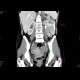 Krukenberg tumor, ovarian metastases from stomach tumour, hydronephrosis: CT - Computed tomography