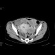 Krukenberg tumor, ovarian metastases from stomach tumour, hydronephrosis: CT - Computed tomography