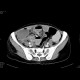Krukenberg tumor, ovarian metastases from stomach tumour, hydronephrosis: CT - Computed tomography