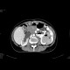 Krukenberg tumor, ovarian metastases from stomach tumour, hydronephrosis: CT - Computed tomography
