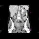 Krukenberg tumor, ovarian metastases from stomach tumour, hydronephrosis: CT - Computed tomography