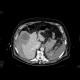 Hepatocellular carcinoma, ruptured, hemoperitoneum: CT - Computed tomography