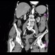 Intramural bleeding in small bowel, bowel wall, intramural hemorrhage: CT - Computed tomography