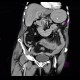 Intramural bleeding in small bowel, bowel wall, intramural hemorrhage: CT - Computed tomography