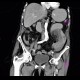 Intramural bleeding in small bowel, bowel wall, intramural hemorrhage: CT - Computed tomography