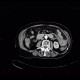 Intramural bleeding in small bowel, bowel wall, intramural hemorrhage: CT - Computed tomography