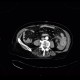 Intramural bleeding in small bowel, bowel wall, intramural hemorrhage: CT - Computed tomography