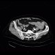 Intramural bleeding in small bowel, bowel wall, intramural hemorrhage: CT - Computed tomography