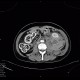 Perirenal hematoma after biopsy: CT - Computed tomography