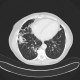 Lymphoid infiltrate in lung parenchyma: CT - Computed tomography