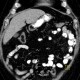 Lipoma in duodenum, small: CT - Computed tomography