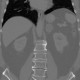 Adrenal adenoma, adenoma of adrenal gland: CT - Computed tomography