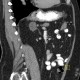 Adrenal adenoma, adenoma of adrenal gland: CT - Computed tomography