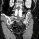 Fibrolipoma in pelvis: CT - Computed tomography