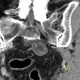 Fibrolipoma in pelvis: CT - Computed tomography