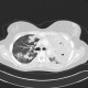 Lymphoma, extension of lymphoma in lung: CT - Computed tomography