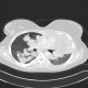 Lymphoma, extension of lymphoma in lung: CT - Computed tomography