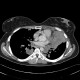 Lymphoma, extension of lymphoma in lung: CT - Computed tomography