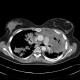 Lymphoma, extension of lymphoma in lung: CT - Computed tomography