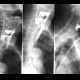 Laryngeal dysphagia, aspiration: RF - Fluoroscopy