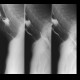 Laryngeal dysphagia, aspiration: RF - Fluoroscopy