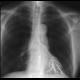 Laryngeal dysphagia, aspiration: RF - Fluoroscopy