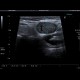 Lateral cervical cyst, complicated: US - Ultrasound