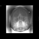 Le Fort II, fracture of facial skeleton: X-ray - Plain radiograph