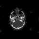 Le Fort II, fracture of facial skeleton: CT - Computed tomography
