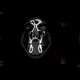 Le Fort II, fracture of facial skeleton: CT - Computed tomography