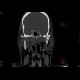 Le Fort II, fracture of facial skeleton: CT - Computed tomography