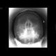 Fracture of facial skeleton, Le Fort III: X-ray - Plain radiograph