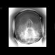 Fracture of facial skeleton, Le Fort III: X-ray - Plain radiograph