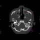 Fracture of facial skeleton, Le Fort III: CT - Computed tomography