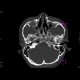 Fracture of facial skeleton, Le Fort III: CT - Computed tomography
