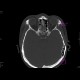 Fracture of facial skeleton, Le Fort III: CT - Computed tomography