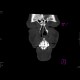 Fracture of facial skeleton, Le Fort III: CT - Computed tomography