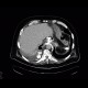 Leak of anastomosis of esophagus in pleural cavity, gastroesophageal anastomosis: CT - Computed tomography