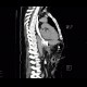 Leak of anastomosis of esophagus in pleural cavity, gastroesophageal anastomosis: CT - Computed tomography