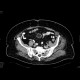 Liposarcoma of mesentery: CT - Computed tomography