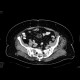 Liposarcoma of mesentery: CT - Computed tomography