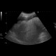 Liver cirrhosis, ascites: US - Ultrasound