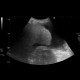 Liver cirrhosis, ascites: US - Ultrasound