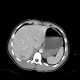 Liver contusion: CT - Computed tomography