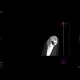 Osseous bridging of the left elbow: CT - Computed tomography
